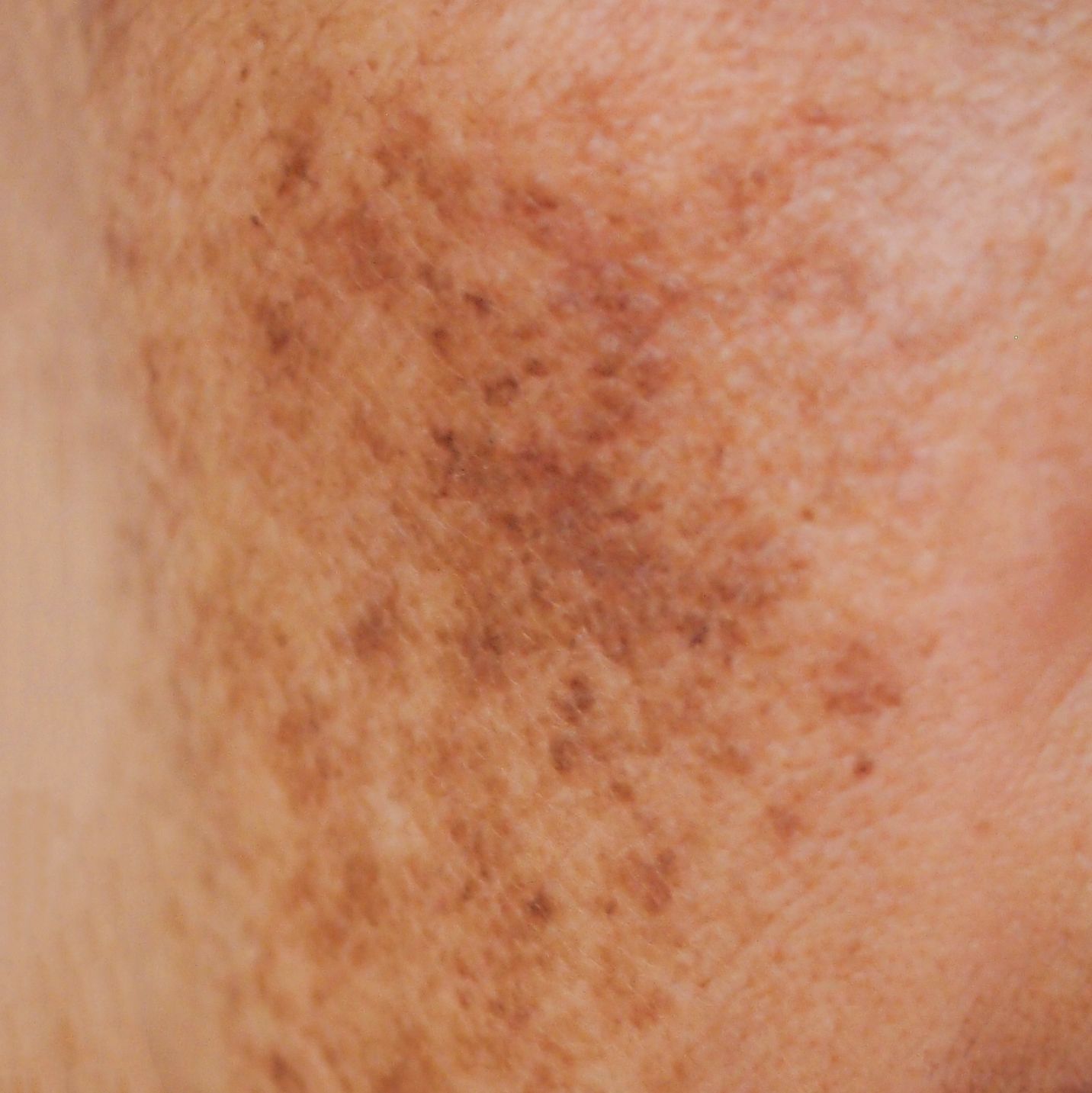 Hyperpigmentation / Melasma