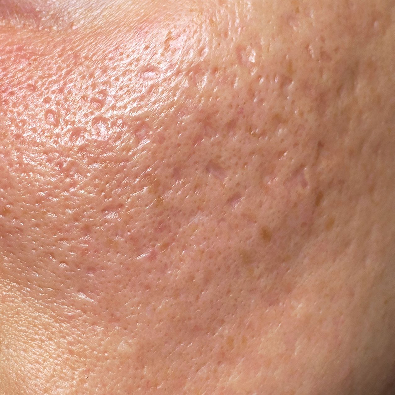 Under-eye hollows and dark circles