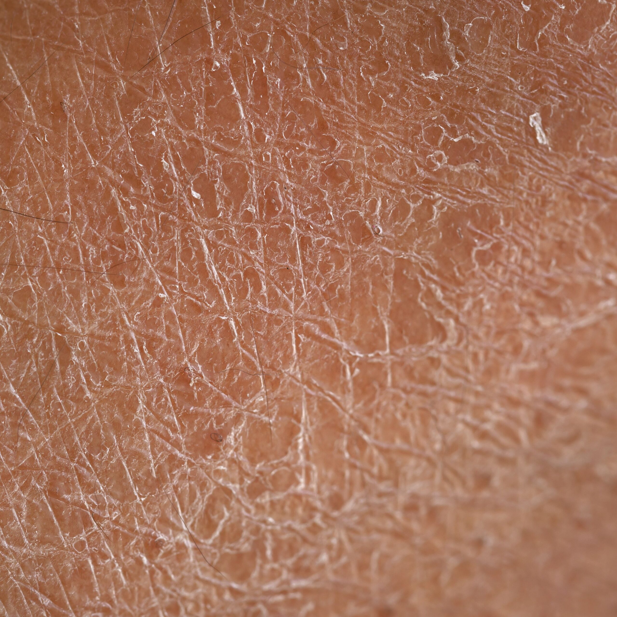 Under-eye hollows and dark circles