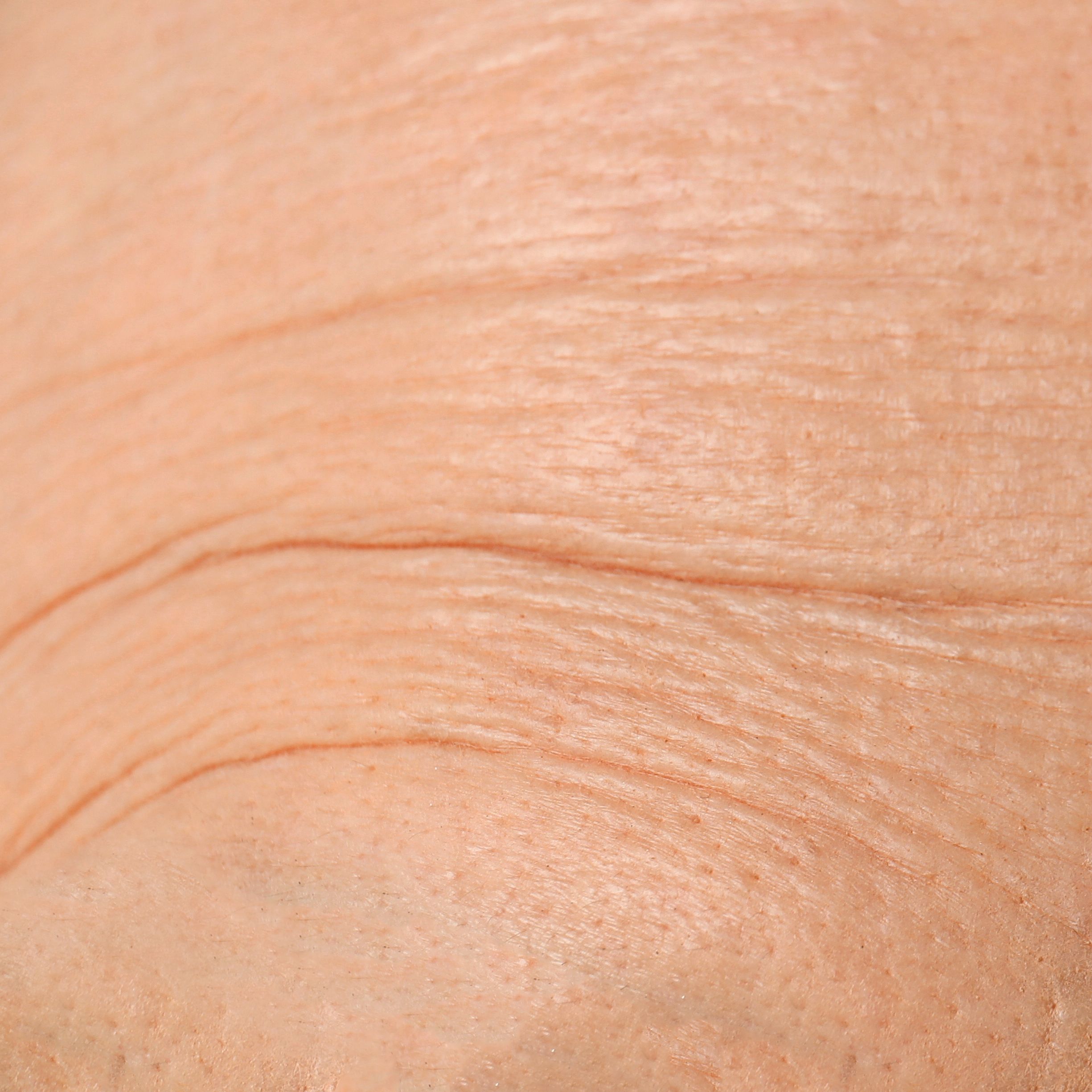 Skin Aging & Wrinkles