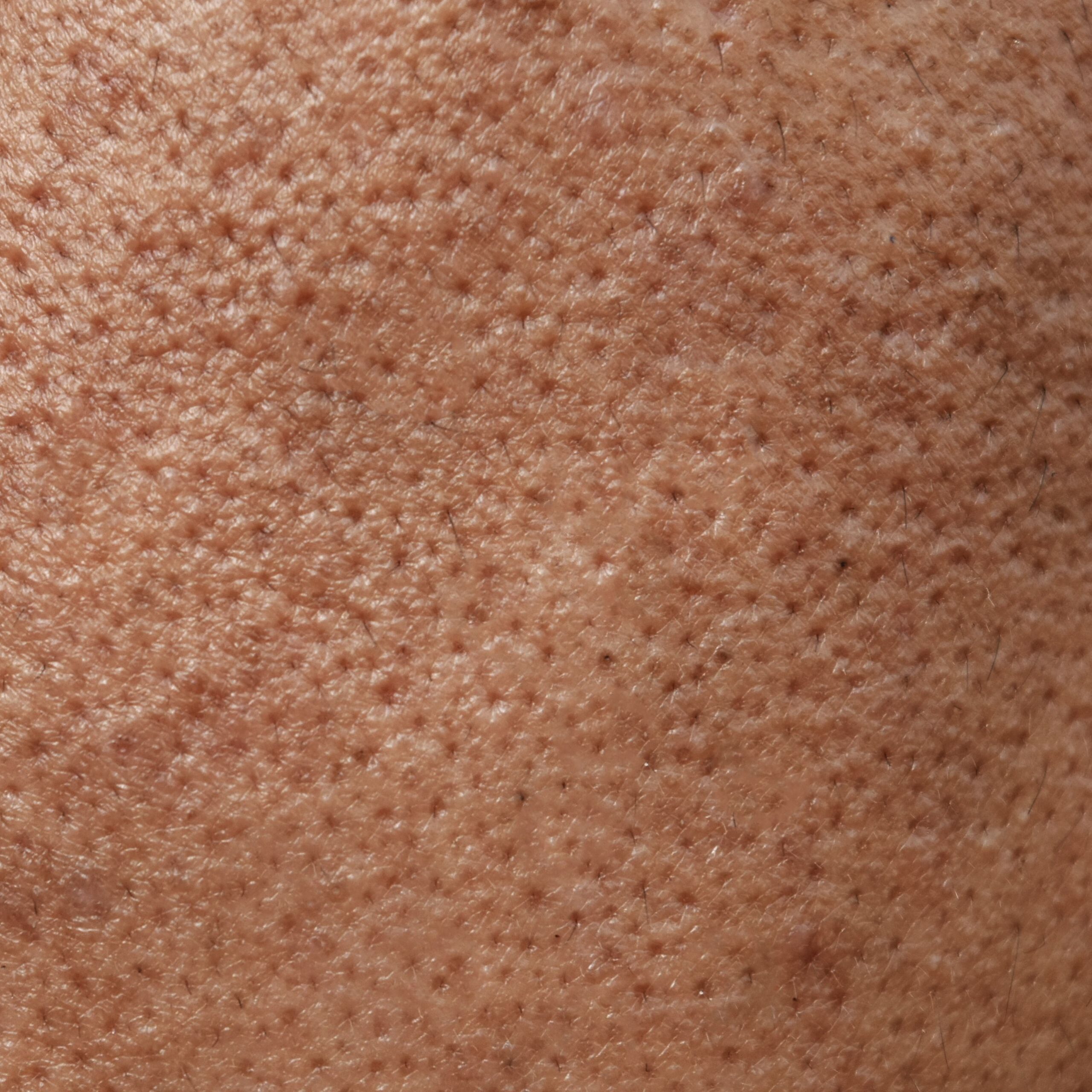 Under-eye hollows and dark circles